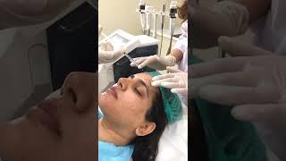 Elevate Your Beauty Routine with RF Microneedling | Aesthetics Lab