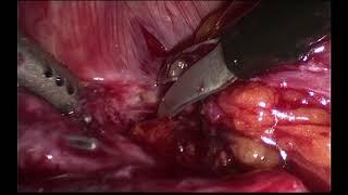 Discoid Bowel Resection for Endometriosis