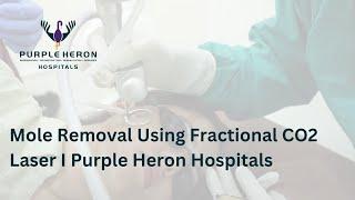 Mole Removal Using Fractional CO2 Laser I Purple Heron Hospitals