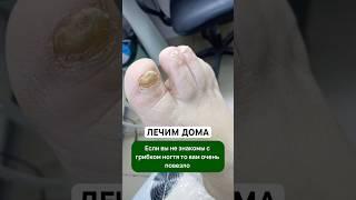 Эффективное средство от грибка ногтей. Артикул - 67774905 