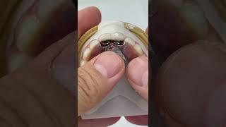 Option for Saving 3 teeth!