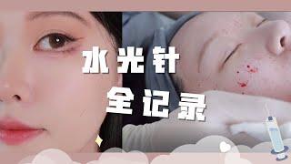 [ENG SUB] 医美 |水光针体验全记录之干皮福音|泰奥水光针| Mesotherapy |TEOSYAL Redensity |Why do Asian girls have good skin