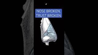 Fixing a Botched Nose…