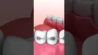 Ceramic Braces VS Metal Braces Complete Guide