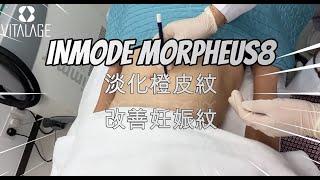 【INMODE Morpheus8 Body 淡化橙皮紋 | 改善妊娠紋】