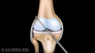 ACL Reconstruction Surgery Animation.