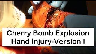 Cherry Bomb Explosion Hand Injury-Version I