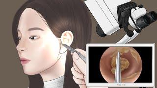 [ASMR] Ear cleaning and Big ear wax removal