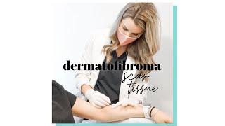 Scar Tissue: Dermatofibroma