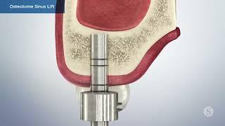 SINUS LIFT SURGERY