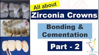 Zirconia Crowns - CEMENTATION vs BONDING.