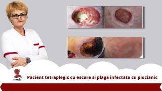 Webinar - Pacient tetraplegic cu escare si plaga infectata cu piocianic #nursery #medatalos #nurse