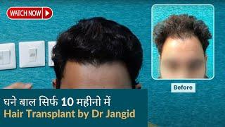 Hair Transplant of a doctor | Before & After 10 महीनो के बाद | Hair transplant results in delhi