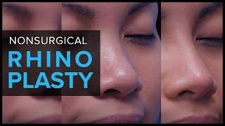 Non-Surgical Rhinoplasty in San Francisco