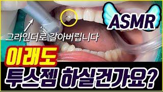 Dental ASMR tooth gem removal (high speed, low speed handpiece sound, resin grinding sound