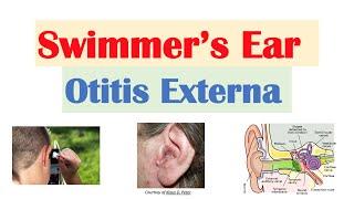 Swimmer’s Ear (Otitis Externa) | Risk Factors, Causes, Signs & Symptoms, Diagnosis, Treatment