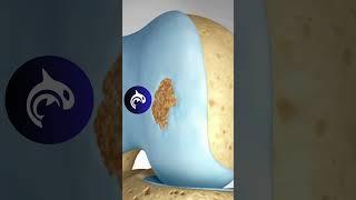 See how Damaged Knee Cartilage is restored in 3D Animation. Osteochondral Autograft (OAT)