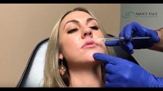 Lip Filler Treatment