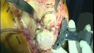 Total Knee Replacement Surgery - MedStar Union Memorial