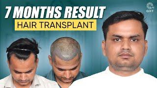 Hair Transplant in Vijayawada | Best Results & Cost of Hair Transplant in Vijayawada