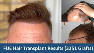 FUE Hair Transplant Results 3251 Grafts | 10.5 Months Update | Dr. Christian BISANGA | BHR Clinic