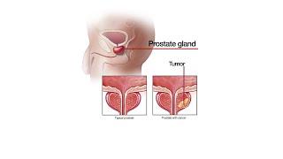 Mayo Clinic Minute - What you should know about prostate cancer screening