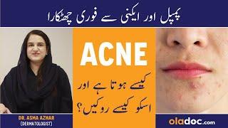 HOW TO GET RID OF PIMPLES - Acne Removal At Home - Acne Treatment - Pimple Khatam Karne Ka Tarika