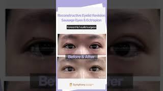 Reconstructive eyelid revision for Puffy, Sausage eyes