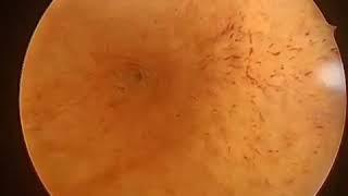 Hysteroscopic septum resection | Dr. Sushmita Mukherjee