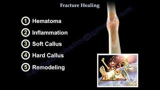 Fracture Healing - Everything You Need To Know - Dr. Nabil Ebraheim