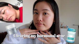 How I cleared my hormonal acne/pimples with otc retinol & probiotics