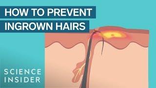 What Are Ingrown Hairs — And How To Treat Them