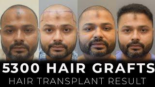 You Won't Believe the Hair Transplant Results Got at Cara Clinic!