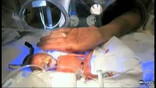 Baby Melinda Video Inspires: Miracle Premature Baby, Size of Human Fist, to Go Home