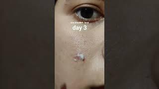 results 5 days of applying adapalene & benzoyl peroxide gel on cystic acne #acne #tretinoin #pimple