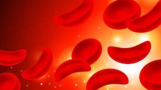 Sickle Cell Anemia