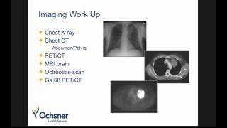 Dr. Robert Ramirez- Basic of Neuroendocrine of the Lungs - June 2016