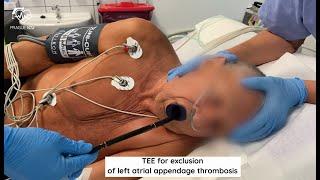 TEE for exclusion of left atrial appendage thrombosis.