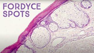 Fordyce Spots ("oil glands") under the microscope (Montgomery tubercles, Tyson glands, sebaceous)