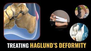 How to TREAT Haglund's Deformity? (Home Treatments and Doctor's Treatment Options) 2021