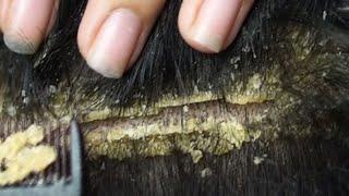 Dandruff scratching removal on head using black combing#53