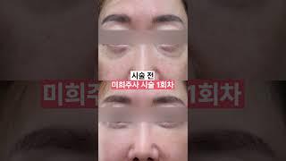수술 없이 가능한 눈밑 지방 재배치!