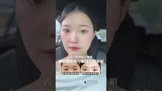 真實案例分享：隱痕雙眼皮＋開眼頭手術｜整形外科醫師鄭穎、晶華美醫診所、晶心美醫集團、台北整形外科