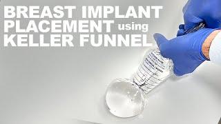 Breast Implant Placement using the Keller Funnel - Dr. Paul Ruff | West End Plastic Surgery