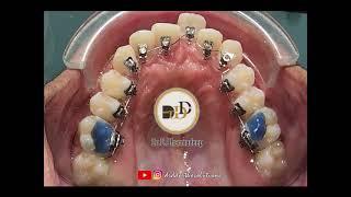 Management of Labially placed Incisor with Selfy Lingual System