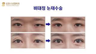 Revision Blepharoplasty : Before & After Symphony Plastic Surgery Korea - Complex Cases