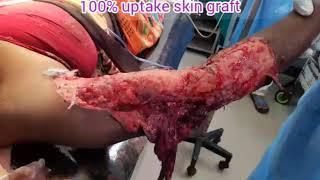 skin grafting