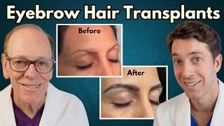 How Eyebrow Hair Transplants Transform Your Look