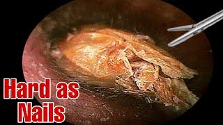 Unbelievable mass of man's Earwax | Earwax removal | Doctor Anh