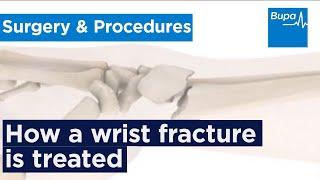 How a wrist fracture is treated | Bupa Health